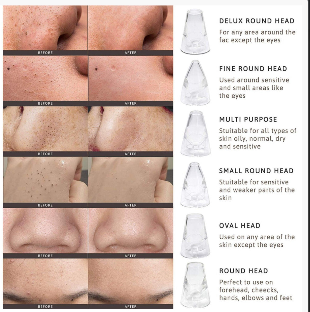 Electric Black Head Remover